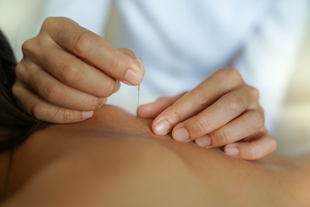 Closeup of haa hand giving dry needling therapy