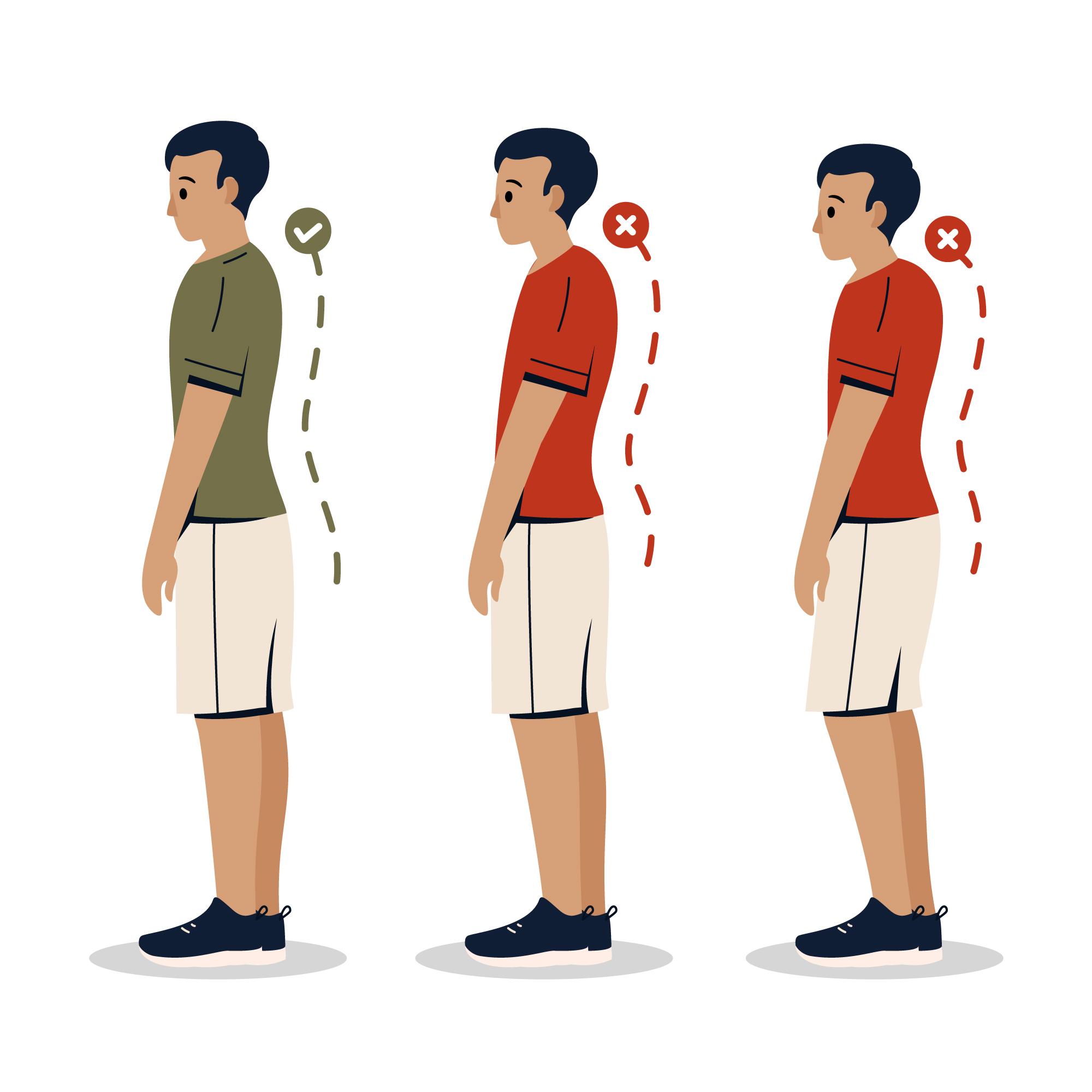 upper crossed syndrome